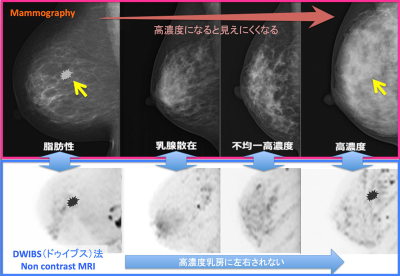 高濃度乳房 MMG vs DWIBS