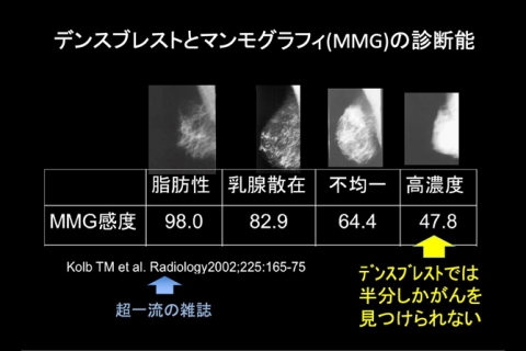 デンスブレストとマンモグラフィ