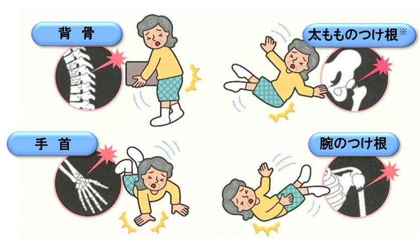 骨粗しょう症の無料相談室 骨粗しょう症になると