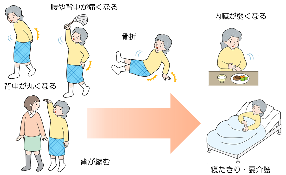 骨粗しょう症の無料相談室 骨粗しょう症になると