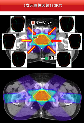 3次元原体照射（3DRT）