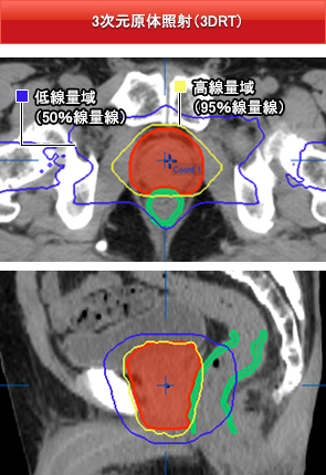 3次元原体照射（3DRT）