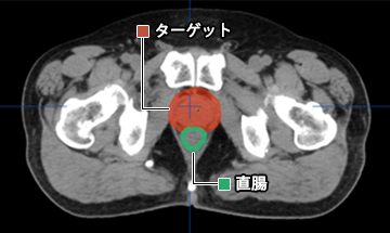 前立腺がん治療時の比較