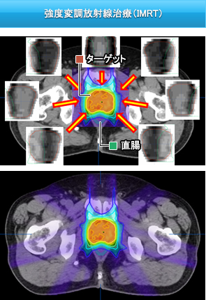 強度変調放射線治療（IMRT）