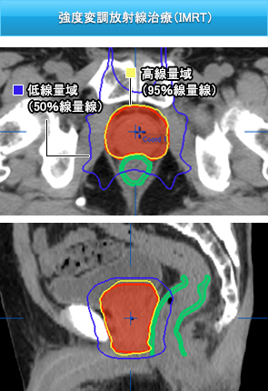 強度変調放射線治療（IMRT）