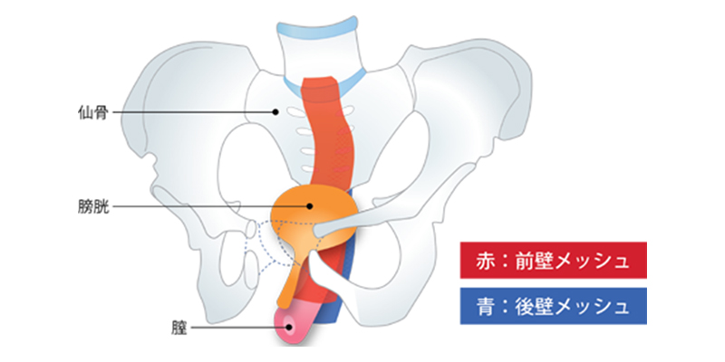 後 子宮 脱 手術 骨盤臓器脱により手術を受ける患者の術前・術後ケア【いまさら聞けない看護技術】