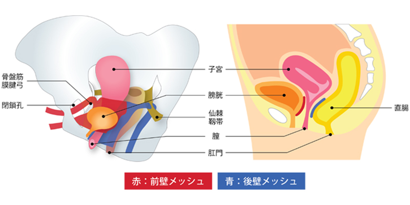 TVM手術