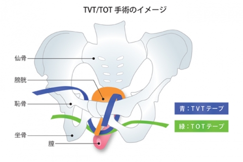 TVT-TOT手術のイメージ