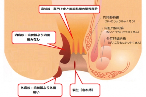 周囲 膿瘍 肛門