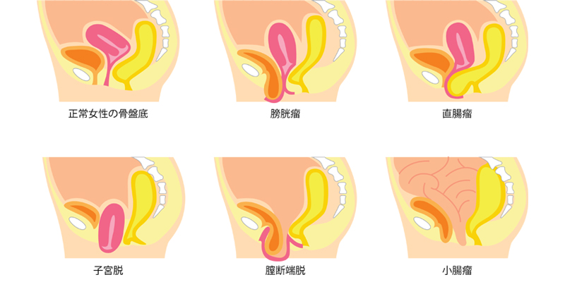 骨盤臓器脱