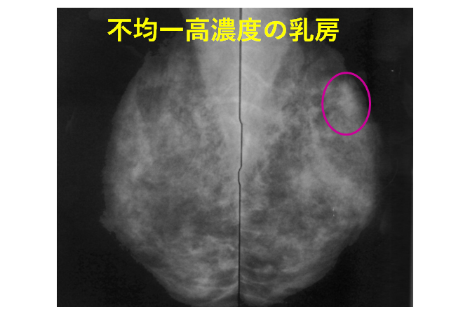 マンモグラフィー画像