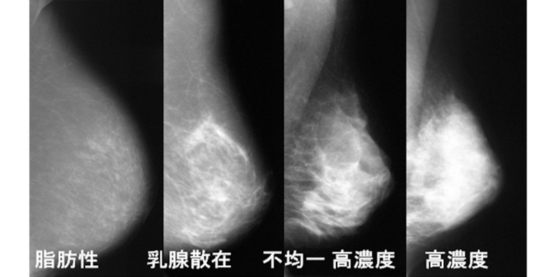 マンモグラフィーの見え方の違い