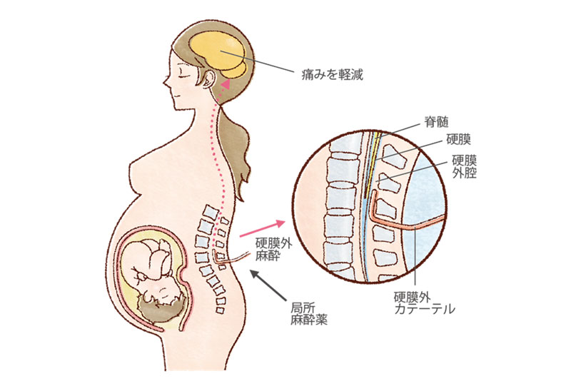 無痛分娩