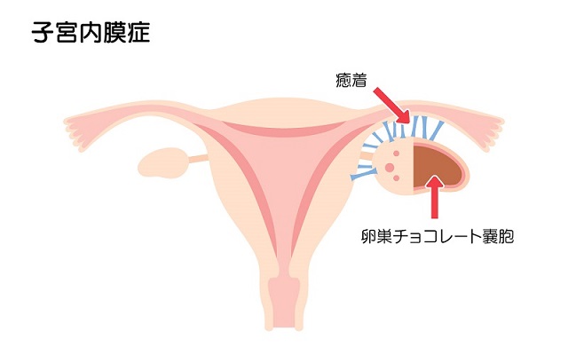 子宮内膜症 ウイミンズメディカルセンター