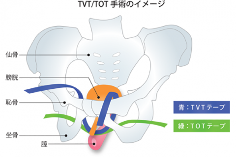 うつ病は勃起不全を引き起こします